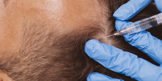 hair loss treatment services with prp injection into missing hair